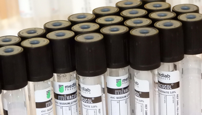 干细胞移植研究成功治愈艾滋病第三人